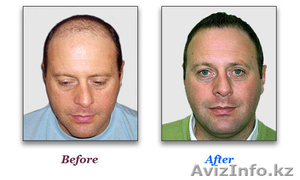 Безоперационная пересадка волос #179610