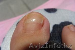 решение броблемы вросших ногтей #319911