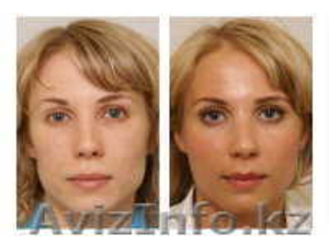 Плазмолифтинг -омоложение на 15-20 лет #366425