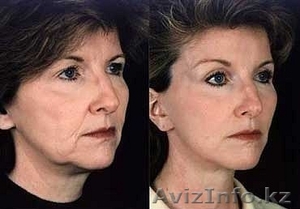 лифтинг-система, лечение угревой сыпи #586292