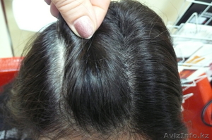 МЕЗОТЕРАПИЯ ,  ДАРСОНВАЛЬ,  ЛЕЧЕНИЕ АКНЕ И ПРОБЛЕМ ПОСТАКНЕ. #751375