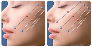 Нитевая подтяжка лица Силуэт Лифт Софт #1036719