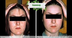 Впервые крем от псориаза 