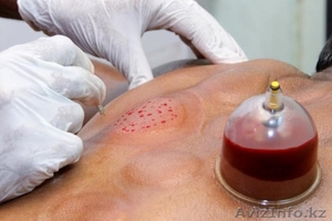 Хиджама - лечение кровопусканием #1266333