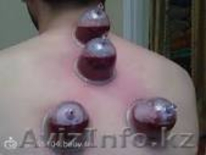 Лечение, восстановление организма Хиджама (кровопускание)  #1313148