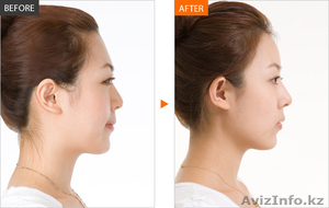 Пластические операции в Южной Корее. Увеличение груди,  липосакция,  итд #1356280