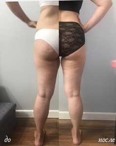 ИЗБАВЬСЯ ОТ ЦЕЛЛЮЛИТА И ЖИРОВЫХ ОТЛОЖЕНИЙ БЕЗОПАСНО И ЭФФЕКТИВНО!!! #1665703