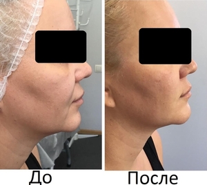  Новый 3D Smas Лифтинг,  новейшая технология,  впервые в Казахстане #1668332