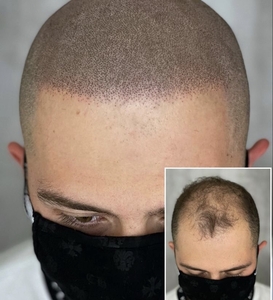 Трихопигментация головы в Алматы #1720226